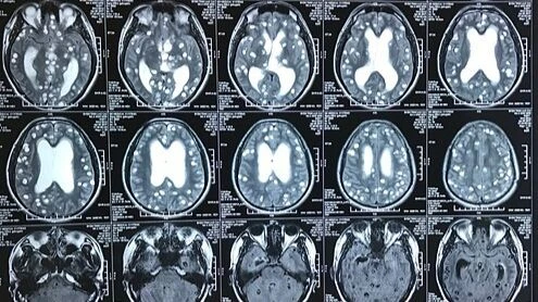 Hoa mắt, nhìn mờ, liệt nửa người... do nhiễm sán não