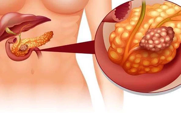 Để không bị viêm tụy cấp ngày Tết