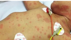 Không để dịch bệnh viêm màng não mô cầu lan rộng tại cộng đồng